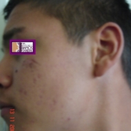 91-ANTES